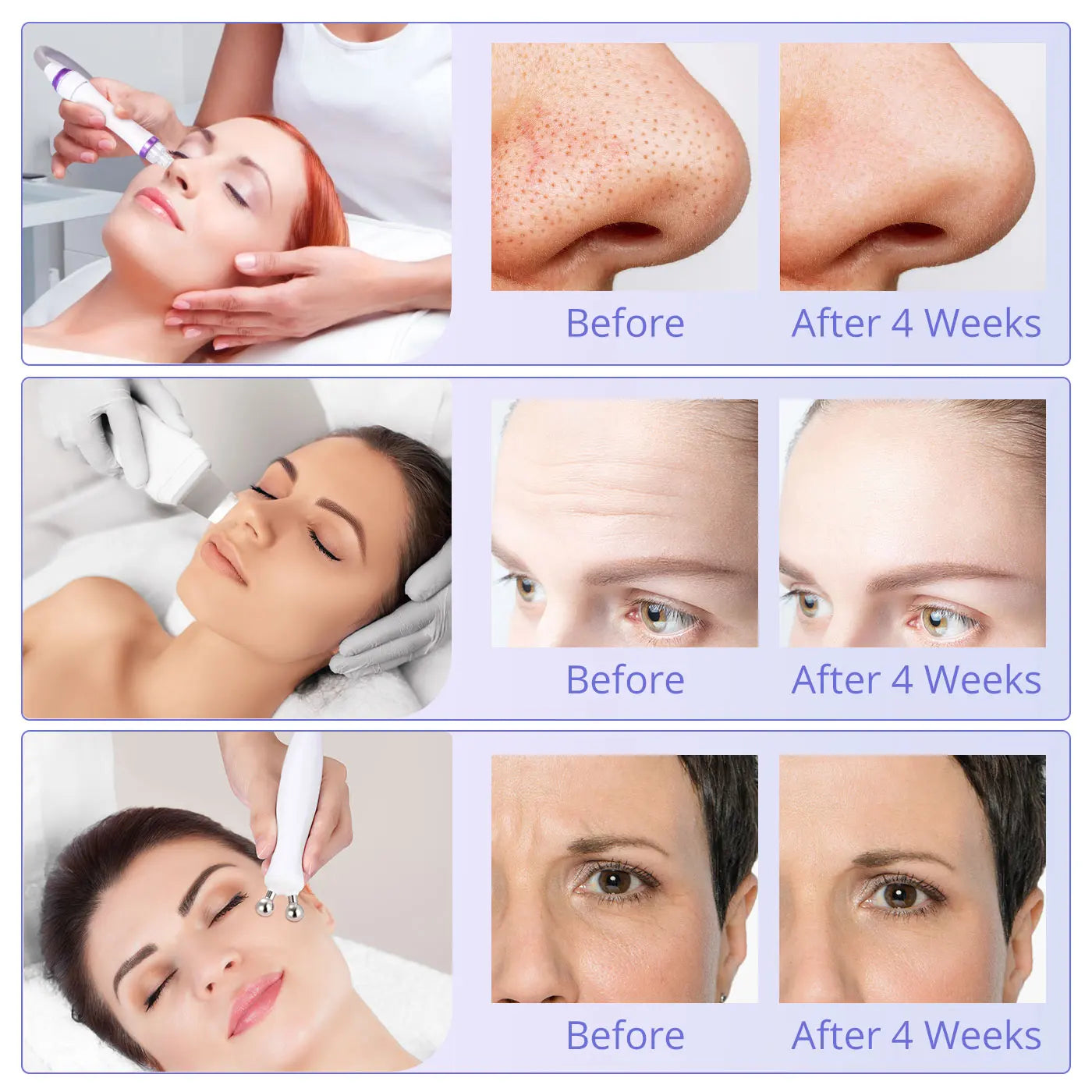 Peneelily Hydro Blackhead Removal Skin Scrubber Facial Clean Machine